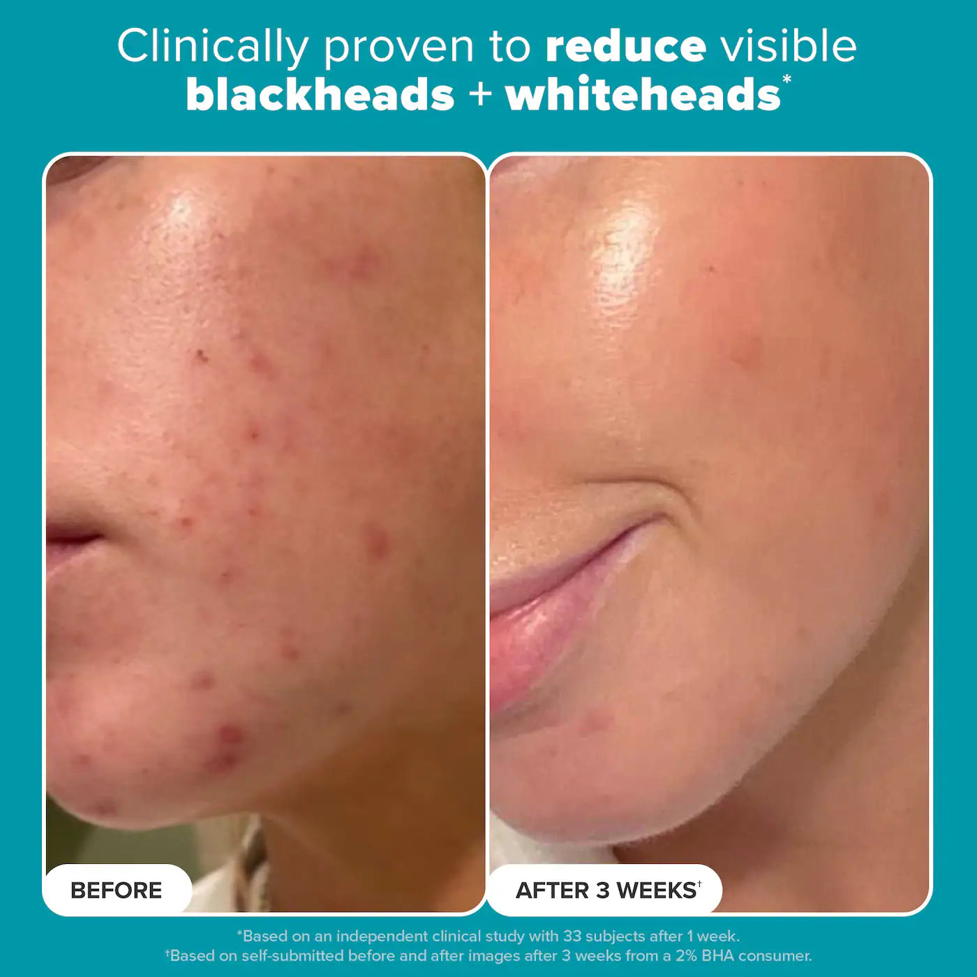Paula's Choice  Skin Perfecting 2% BHA Liquid Exfoliating Toner for Clear Skin