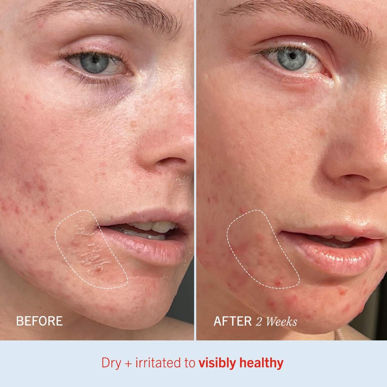 First Aid Beauty  Ultra Repair® Cream Intense Hydration – Face and Body Moisturizer for Skin Repair