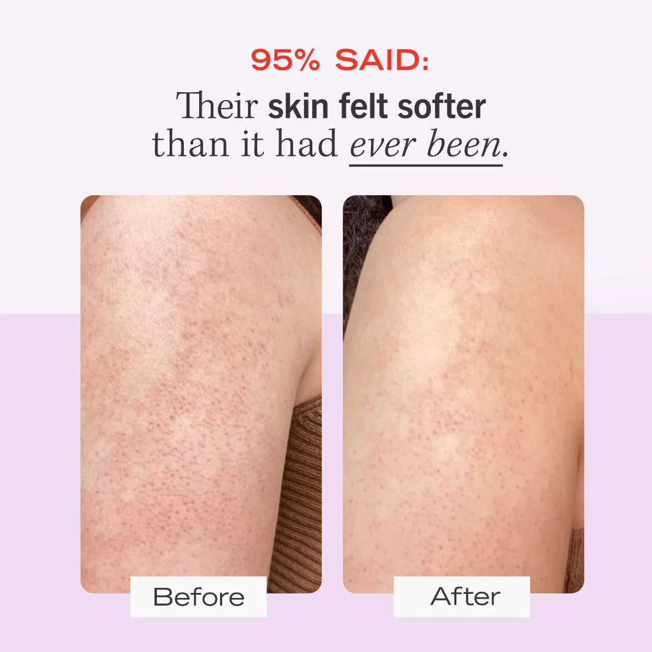 First Aid Beauty  KP Bump Eraser Body Scrub with 10% AHA – Body Exfoliant for Keratosis Pilaris