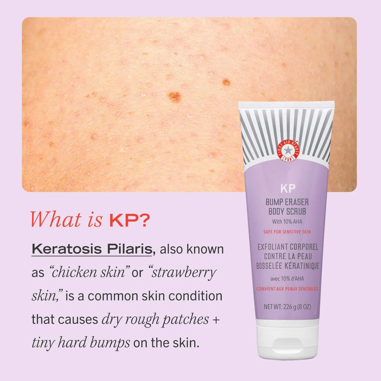 First Aid Beauty  KP Bump Eraser Body Scrub with 10% AHA – Body Exfoliant for Keratosis Pilaris