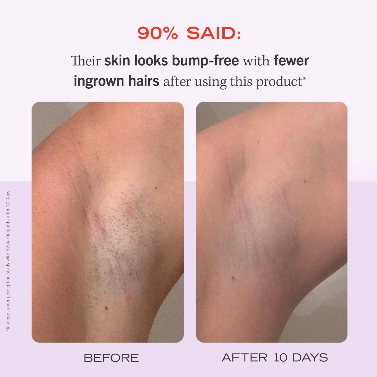 First Aid Beauty  Ingrown Hair Pads with BHA & AHA