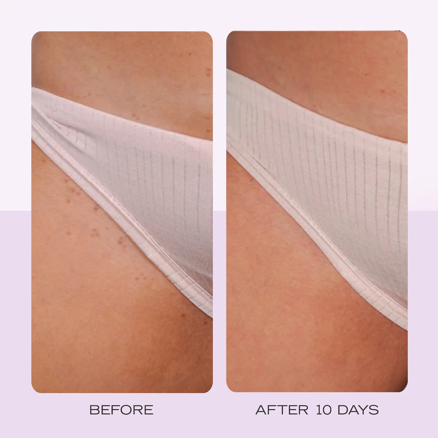 First Aid Beauty  Ingrown Hair Pads with BHA & AHA