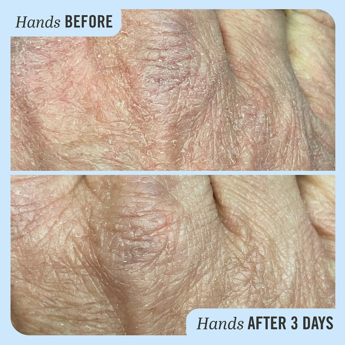 First Aid Beauty  Ultra Repair® Cream Intense Hydration – Face and Body Moisturizer for Skin Repair